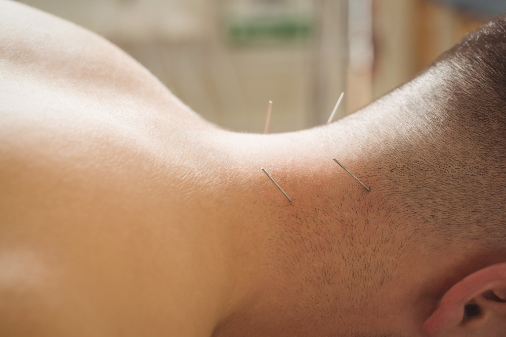 Acupuncture for neck stiffness
